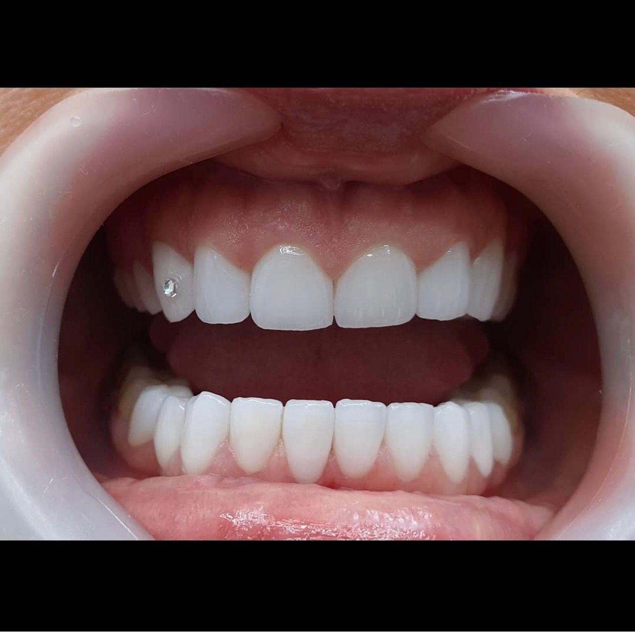 Dopo il trattamento - Faccette dentali